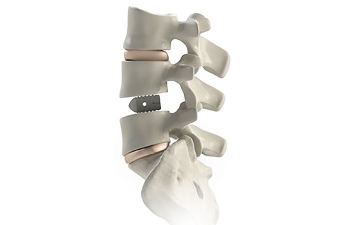 PEEK Orthopedic Implants